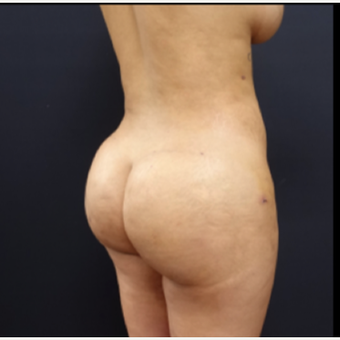 25-34 year old woman treated with Tumescent Liposuction after 3280020