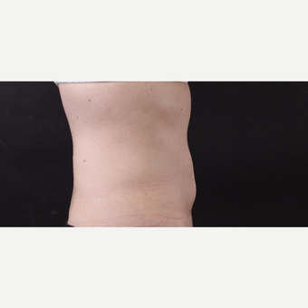 49 year old woman treated with CoolSculpting after 3630295
