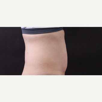 49 year old woman treated with CoolSculpting before 3630295