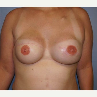 DIEP flap breast reconstruction after 1710786