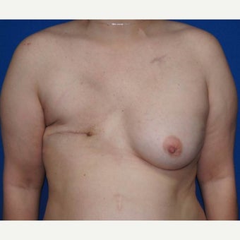 DIEP flap breast reconstruction before 1710786