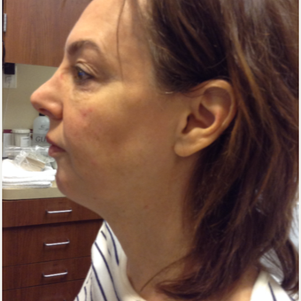 55-64 year old woman treated with Bellafill before 3815778