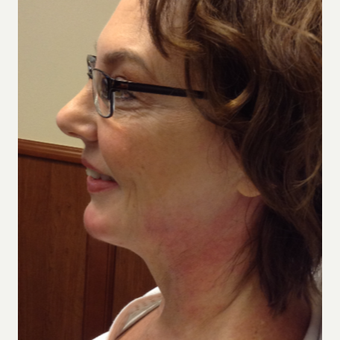55-64 year old woman treated with Bellafill after 3815778