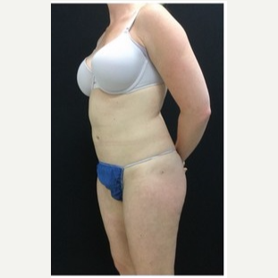 25-34 year old woman treated with Liposuction to Abdomen & Thighs after 3200809