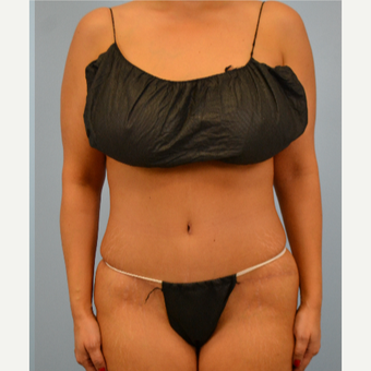 32 year old woman treated with Tummy Tuck after 3432229