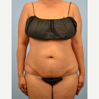 32 year old woman treated with Tummy Tuck before 3432229