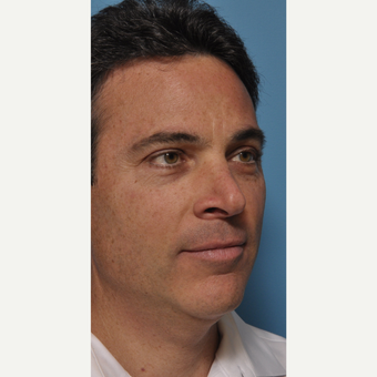 Rhinoplasty, Chin Implant, Neck Liposuction before 3254896