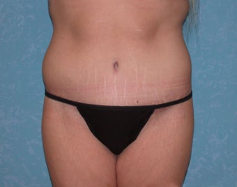 Circumferential Body Lift after 856548
