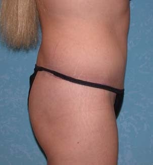 Circumferential Body Lift 856548
