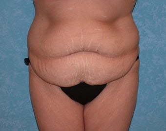 Circumferential Body Lift before 856548