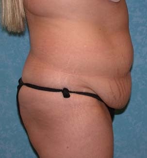Circumferential Body Lift 856548