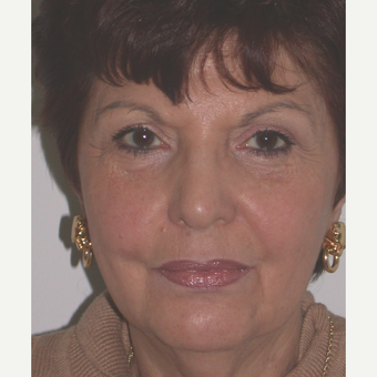 65-74 year old woman treated with Facelift before 3261760
