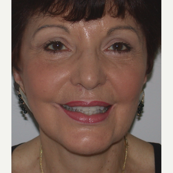 65-74 year old woman treated with Facelift after 3261760
