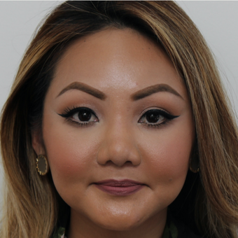 25-34 year old woman treated with Revision Rhinoplasty before 3583597