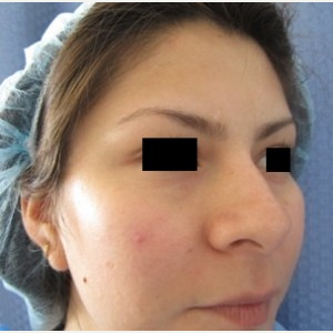 Rhinoplasty before 2994558