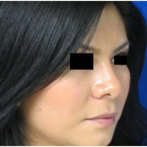 Rhinoplasty after 2994558
