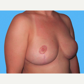 Breast Implant Removal after 3831813