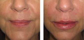 Restylane before 945700
