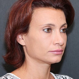 Sculptra after 1156166