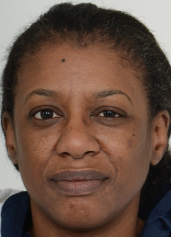 35-44 year old woman treated with African American Rhinoplasty before 1728619