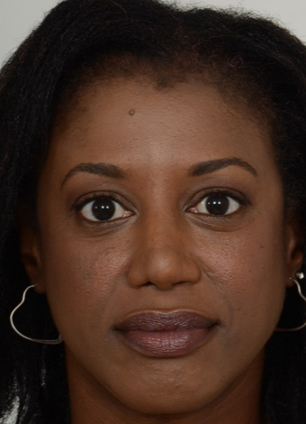 35-44 year old woman treated with African American Rhinoplasty after 1728619