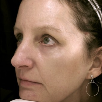 45-54 year old woman treated with Eye Bags Treatment after 3441375