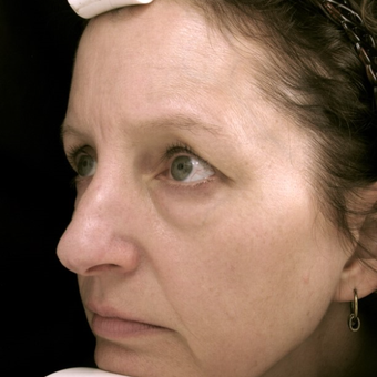 45-54 year old woman treated with Eye Bags Treatment before 3441375