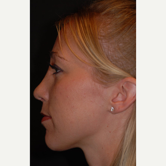 26 year old woman treated with rhinoplasty after 3839730