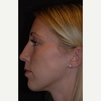 26 year old woman treated with rhinoplasty before 3839730