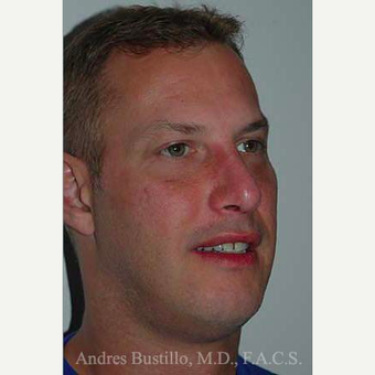 38 year old man treated with Revision Rhinoplasty after 3460800