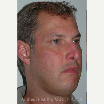 38 year old man treated with Revision Rhinoplasty before 3460800
