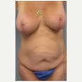 47 year old woman treated with Mommy Makeover after 3680029