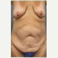 47 year old woman treated with Mommy Makeover before 3680029