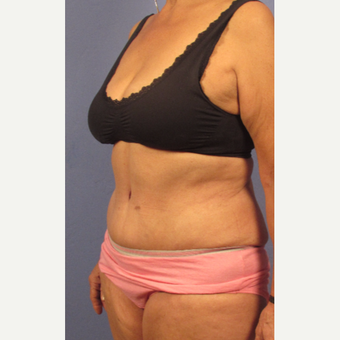 45-54 year old woman treated with Tummy Tuck after 3131876