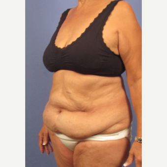 45-54 year old woman treated with Tummy Tuck before 3131876