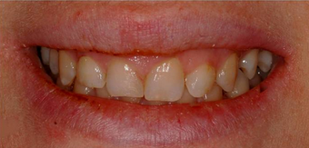Laser Gum Reshaping, Gingivoplasty, Gingivectomy and Veneers before 1271712
