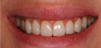 Laser Gum Reshaping, Gingivoplasty, Gingivectomy and Veneers after 1271712