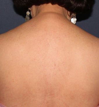 64 year old female with brown spots and red spots on her back. Treated with Vbeam and alex lasers after 1287722