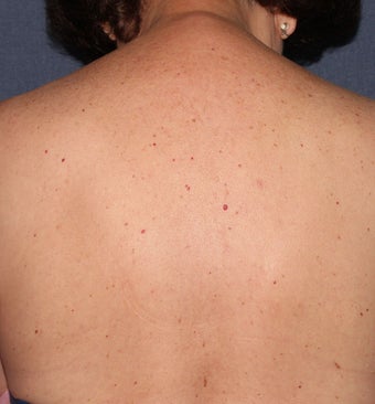 64 year old female with brown spots and red spots on her back. Treated with Vbeam and alex lasers before 1287722