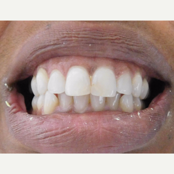 Porcelain Veneers and crowns Female Patient before 3838045