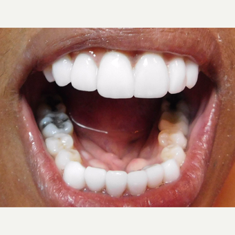Porcelain Veneers and crowns Female Patient after 3838045