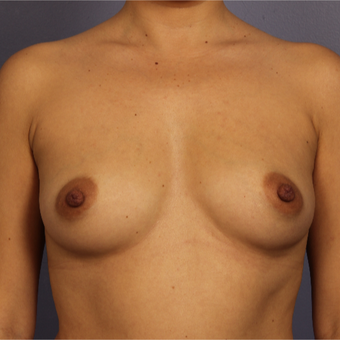 Breast Augmentation before 3646939
