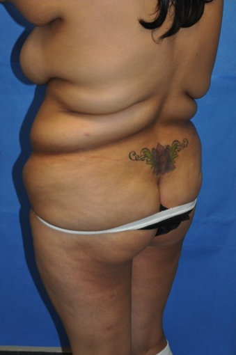 Brazilian Butt Lift and Tummy Tuck before 1235797