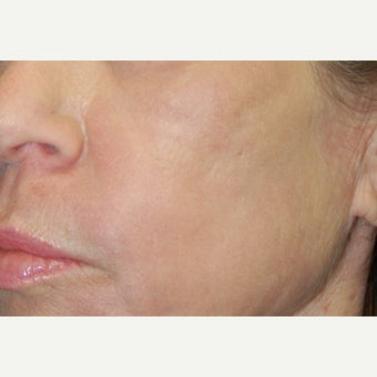 45-54 year old woman treated with Phenol Peel after 2167360