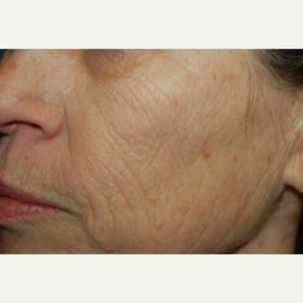 45-54 year old woman treated with Phenol Peel before 2167360