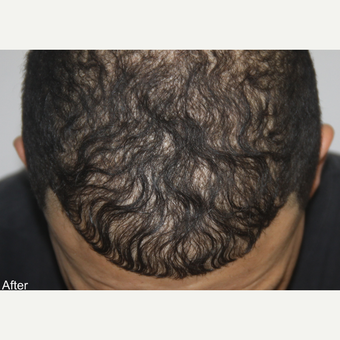 25-34 year old man treated with FUE Hair Transplant after 3616894