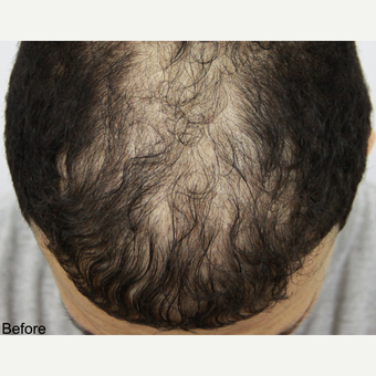 25-34 year old man treated with FUE Hair Transplant before 3616894