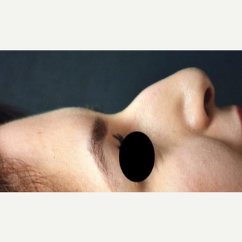 25-34 year old woman treated with Rhinoplasty before 3211281