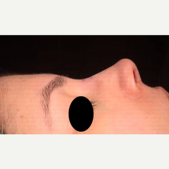 25-34 year old woman treated with Rhinoplasty after 3211281