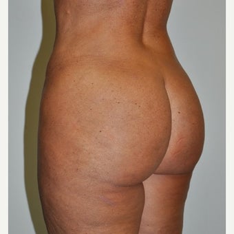 45-54 year old woman treated with Brazilian Butt Lift after 2677661